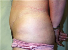 Tummy Tuck After Photo by Stanley Castor, MD; Tampa, FL - Case 39341