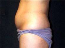 Tummy Tuck Before Photo by Stanley Castor, MD; Tampa, FL - Case 39341