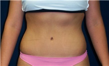Tummy Tuck After Photo by Stanley Castor, MD; Tampa, FL - Case 39342