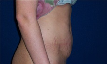 Tummy Tuck Before Photo by Stanley Castor, MD; Tampa, FL - Case 39342