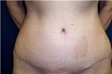 Tummy Tuck After Photo by Stanley Castor, MD; Tampa, FL - Case 39343