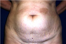 Tummy Tuck Before Photo by Stanley Castor, MD; Tampa, FL - Case 39343