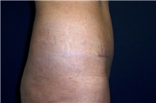 Tummy Tuck After Photo by Stanley Castor, MD; Tampa, FL - Case 39343