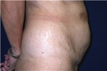 Tummy Tuck Before Photo by Stanley Castor, MD; Tampa, FL - Case 39343