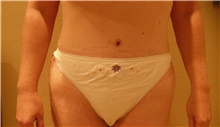 Tummy Tuck After Photo by Stanley Castor, MD; Tampa, FL - Case 39344