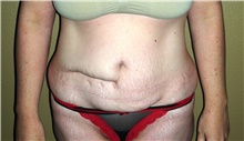 Tummy Tuck Before Photo by Stanley Castor, MD; Tampa, FL - Case 39344