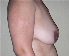 Breast Lift Before Photo by Stanley Castor, MD; Tampa, FL - Case 39423