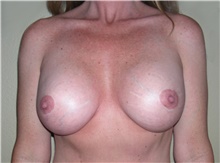 Breast Lift After Photo by Stanley Castor, MD; Tampa, FL - Case 39425