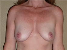 Breast Lift Before Photo by Stanley Castor, MD; Tampa, FL - Case 39425
