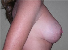 Breast Lift After Photo by Stanley Castor, MD; Tampa, FL - Case 39425