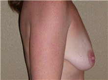 Breast Lift Before Photo by Stanley Castor, MD; Tampa, FL - Case 39425
