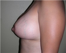 Breast Lift After Photo by Stanley Castor, MD; Tampa, FL - Case 39428