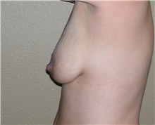 Breast Lift Before Photo by Stanley Castor, MD; Tampa, FL - Case 39428