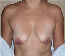Breast Lift Before Photo by Stanley Castor, MD; Tampa, FL - Case 39429