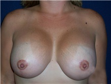 Breast Lift After Photo by Stanley Castor, MD; Tampa, FL - Case 39432