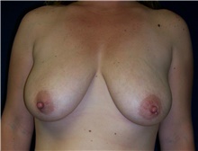 Breast Lift Before Photo by Stanley Castor, MD; Tampa, FL - Case 39432