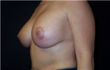 Breast Lift After Photo by Stanley Castor, MD; Tampa, FL - Case 39434