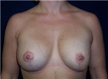 Breast Lift After Photo by Stanley Castor, MD; Tampa, FL - Case 39436