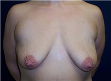 Breast Lift Before Photo by Stanley Castor, MD; Tampa, FL - Case 39436