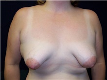 Breast Lift Before Photo by Stanley Castor, MD; Tampa, FL - Case 39437