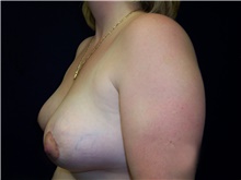 Breast Lift After Photo by Stanley Castor, MD; Tampa, FL - Case 39437