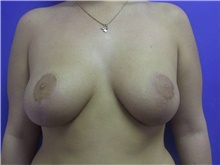 Breast Reduction After Photo by Stanley Castor, MD; Tampa, FL - Case 39441