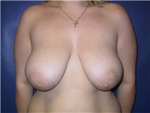 Breast Reduction Before Photo by Stanley Castor, MD; Tampa, FL - Case 39441