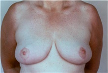 Breast Reduction After Photo by Stanley Castor, MD; Tampa, FL - Case 39442