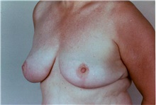 Breast Reduction After Photo by Stanley Castor, MD; Tampa, FL - Case 39442