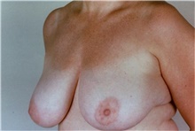 Breast Reduction Before Photo by Stanley Castor, MD; Tampa, FL - Case 39442