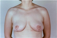 Breast Reduction After Photo by Stanley Castor, MD; Tampa, FL - Case 39443