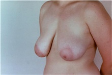 Breast Reduction Before Photo by Stanley Castor, MD; Tampa, FL - Case 39443