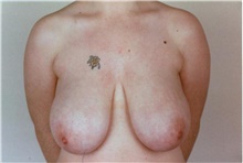 Breast Reduction Before Photo by Stanley Castor, MD; Tampa, FL - Case 39444