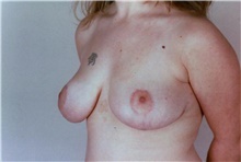 Breast Reduction After Photo by Stanley Castor, MD; Tampa, FL - Case 39444
