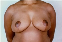 Breast Reduction After Photo by Stanley Castor, MD; Tampa, FL - Case 39445