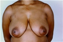 Breast Reduction Before Photo by Stanley Castor, MD; Tampa, FL - Case 39445