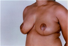 Breast Reduction After Photo by Stanley Castor, MD; Tampa, FL - Case 39445