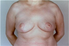 Breast Reduction After Photo by Stanley Castor, MD; Tampa, FL - Case 39447