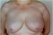 Breast Reduction Before Photo by Stanley Castor, MD; Tampa, FL - Case 39447