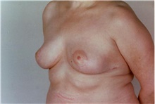 Breast Reduction After Photo by Stanley Castor, MD; Tampa, FL - Case 39447