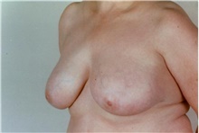 Breast Reduction Before Photo by Stanley Castor, MD; Tampa, FL - Case 39447