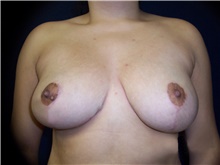 Breast Reduction After Photo by Stanley Castor, MD; Tampa, FL - Case 39448
