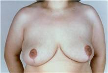 Breast Reduction After Photo by Stanley Castor, MD; Tampa, FL - Case 39449