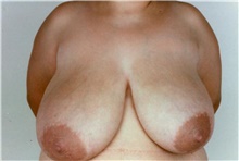 Breast Reduction Before Photo by Stanley Castor, MD; Tampa, FL - Case 39449