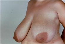 Breast Reduction Before Photo by Stanley Castor, MD; Tampa, FL - Case 39449