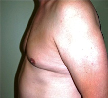 Male Breast Reduction Before Photo by Stanley Castor, MD; Tampa, FL - Case 39454