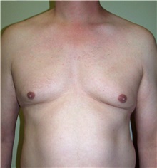 Male Breast Reduction Before Photo by Stanley Castor, MD; Tampa, FL - Case 39455