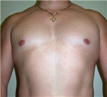 Male Breast Reduction After Photo by Stanley Castor, MD; Tampa, FL - Case 39456