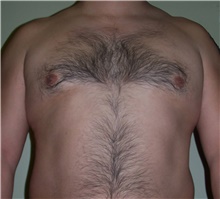 Male Breast Reduction Before Photo by Stanley Castor, MD; Tampa, FL - Case 39456