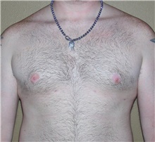 Male Breast Reduction After Photo by Stanley Castor, MD; Tampa, FL - Case 39457
